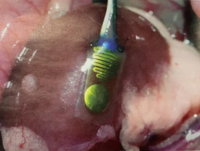Reprogrammed Immune Cells Hunt Down and Destroy Cancer Cells