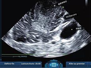 Anatomically Precise Ultrasound-Based Technique to Enable Noninvasive Biopsies for Brain Tumors