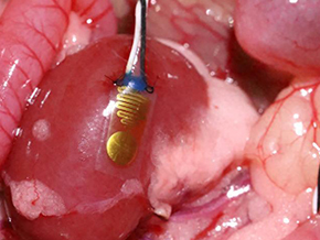 First-Ever Implantable Device Detects Organ Transplant Rejection Three Weeks Earlier Than Current Me