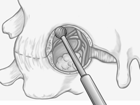 New Keyhole Surgery Technique for Prostate Cancer Reduces Postoperative Complications