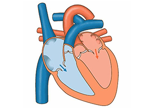 First-Of-Its-Kind Technology Enables Replacement of Diseased Heart Valve without Surgery