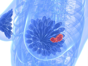 Fast PET/MRI Protocol Cuts Breast Cancer Scan Times in Half