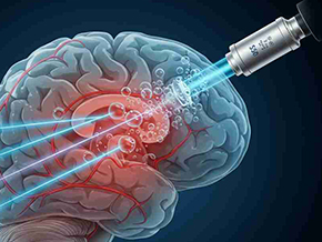 Microbubble Technology Helps Surgeons Target Cancer with Ultrasound