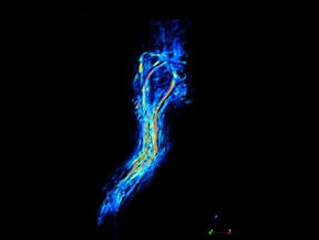 ‘Molecular Imaging’Lights up Tumors for Surgeons to Enable Precise Removal